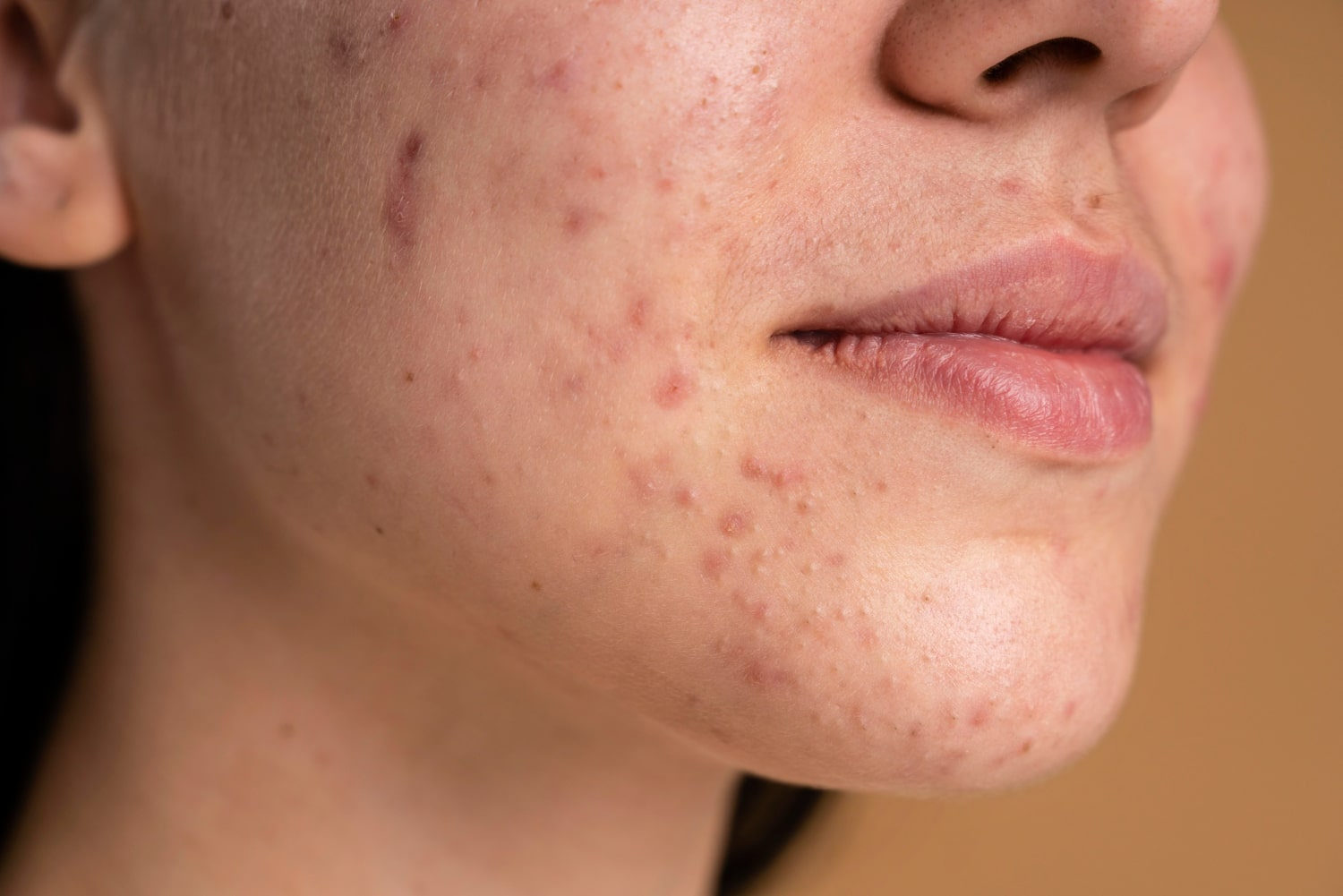 /Upload/image/2023/06/19/upload_confident-young-woman-with-acne-close-up-min_190623-034505.png
