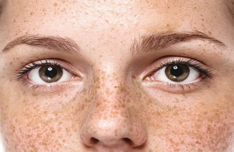 Laser trị tàn nhang/đồi mồi 
